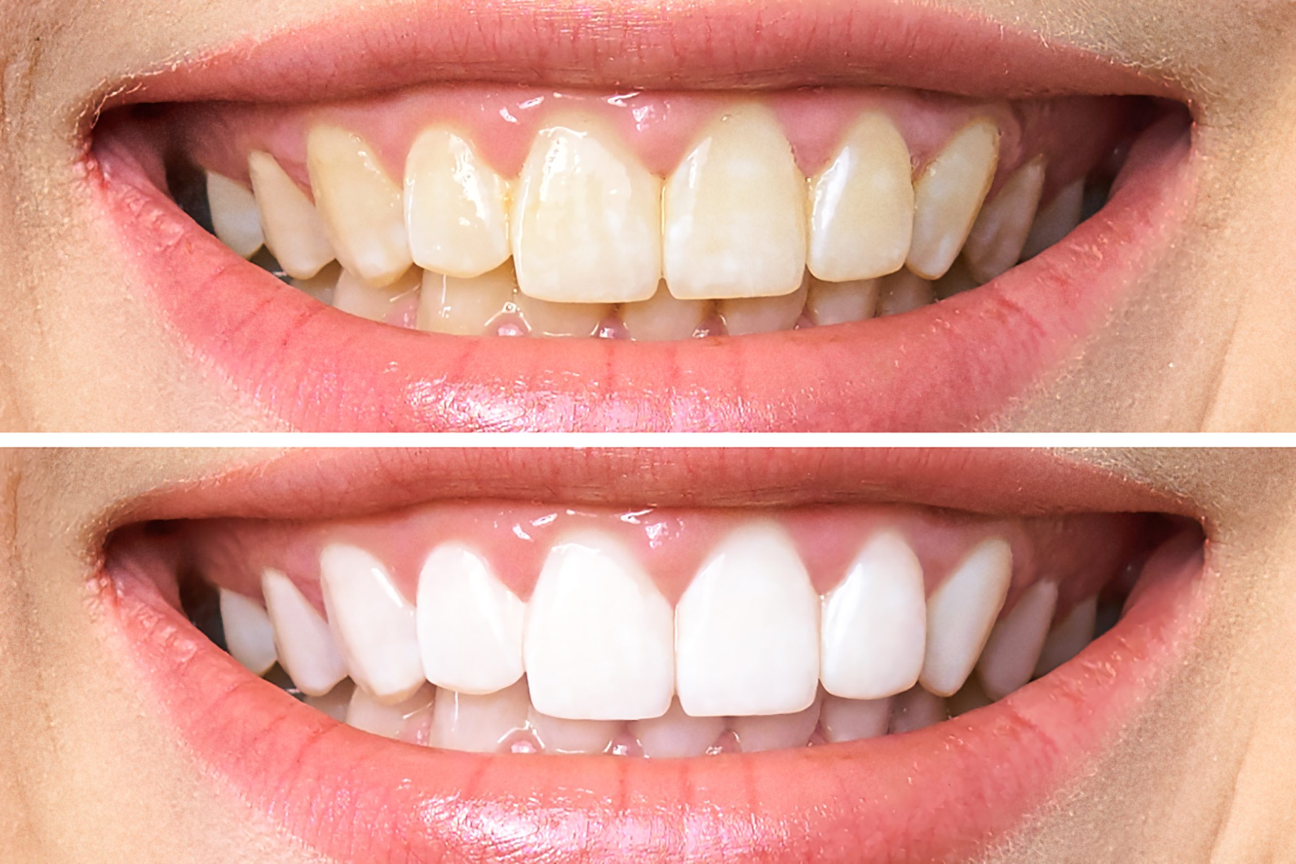 teeth whitening burleson